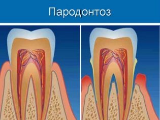 Почему сухость во рту это плохо