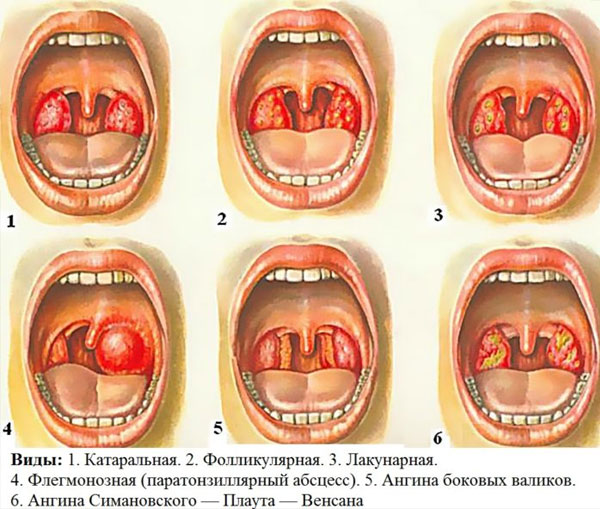 Что можно сделать, если гланды опухли