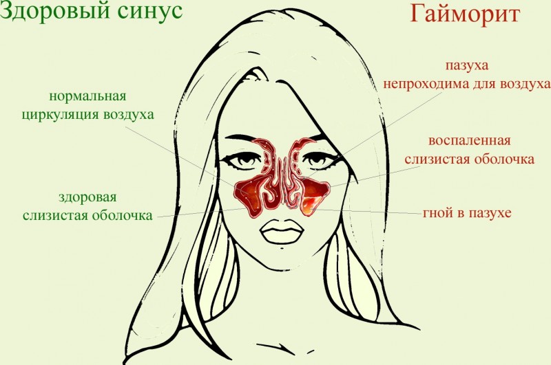 Какие признаки и как лечить катаральный синусит