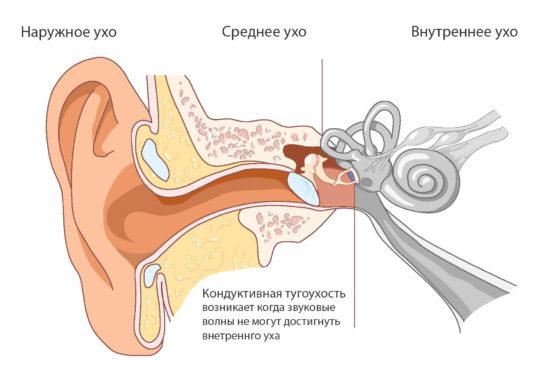 Кондуктивная тугоухость