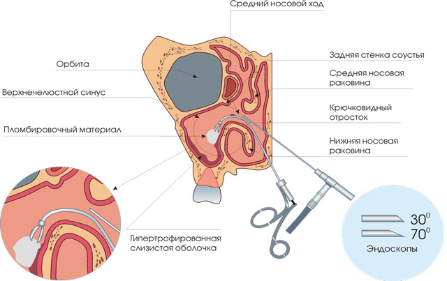 Опасна ли киста в носовой пазухе