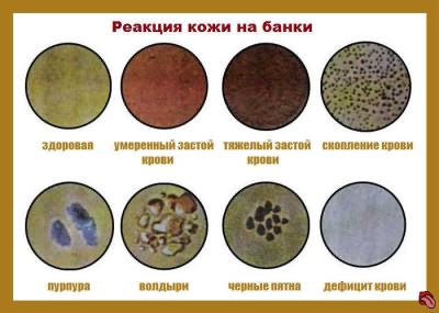 Как правильно ставить банки на спину