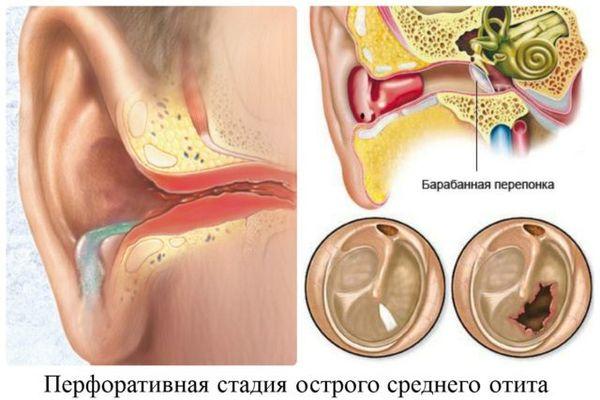 Холестеатома уха признаки, осложнения и лечение