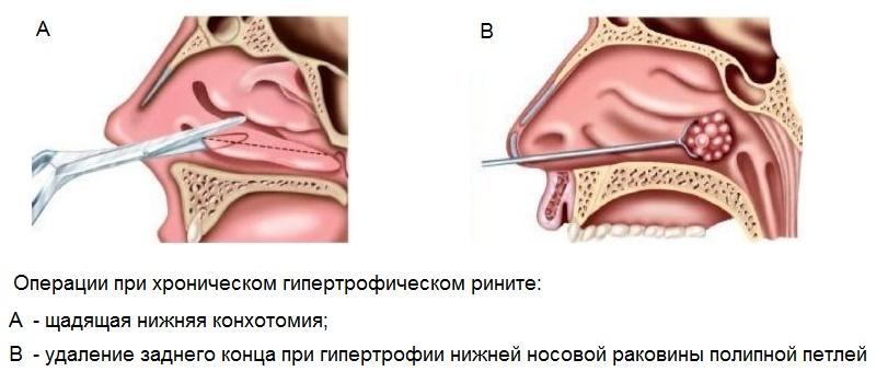 Что такое конхотомия носовых раковин