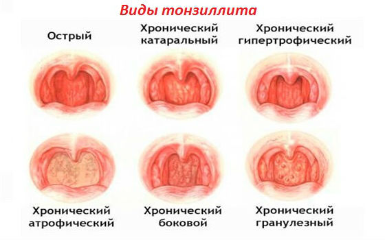 Первые признаки и лечение тонзиллита у ребенка