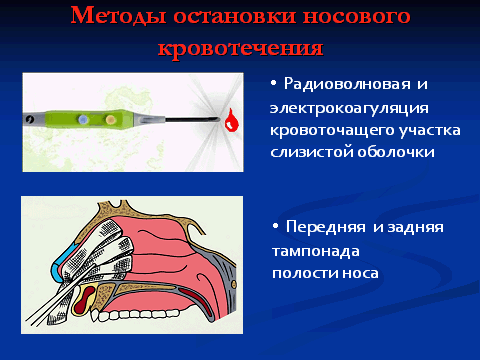 Неотложная помощь при носовых кровотечениях