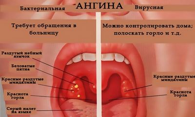 Каким способом передается ангина