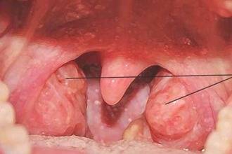 Лечение воспаления носоглотки в домашних условиях