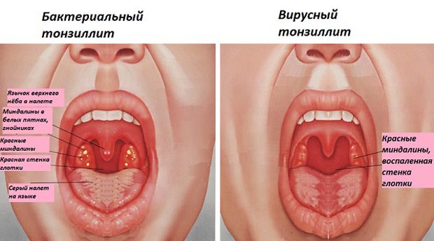 Сиптомы и лечение острого тонзиллита