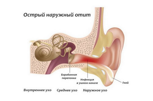 Острый средний отит лечение