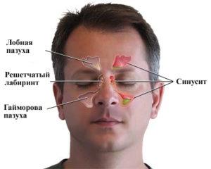 заболеванием, киста, патологическим