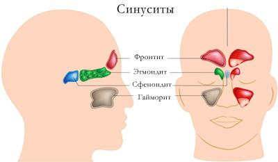 Заболевания лобных пазух