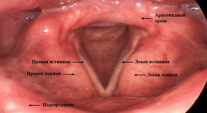 Как и чем лечить воспаление голосовых связок причины и профилактика недуга