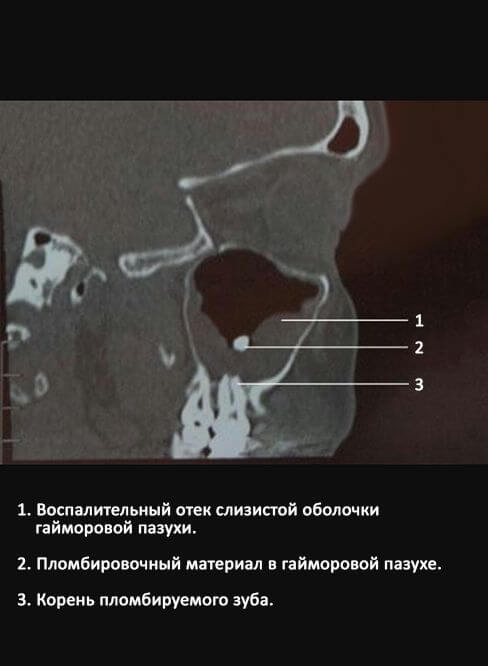 Причины возникновения мицетомы гайморовой пазухи