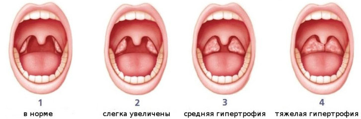 Увеличение аденоидов у детей 1, 2 и 3 степени