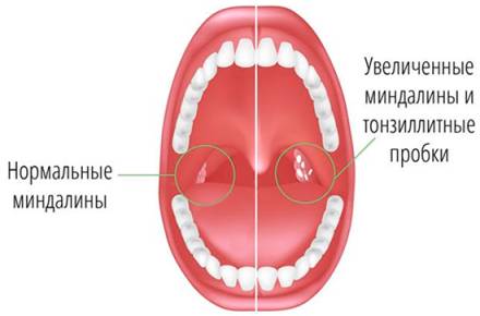 Симптомы тонзиллитных пробок