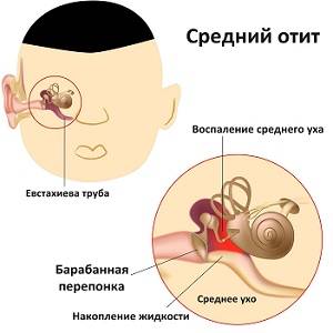 Избавляемся от боли в ухе быстро