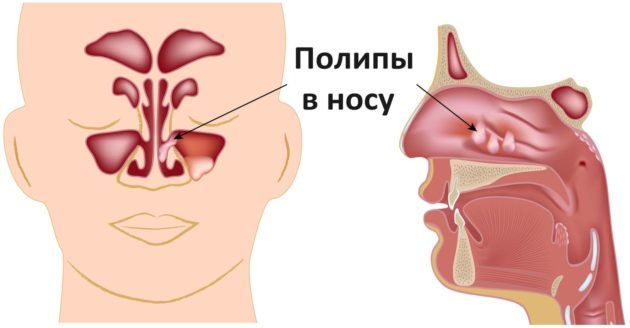 Одна из причин возникновения частого чихания и насморка