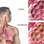 Пневмония – что это за болезнь