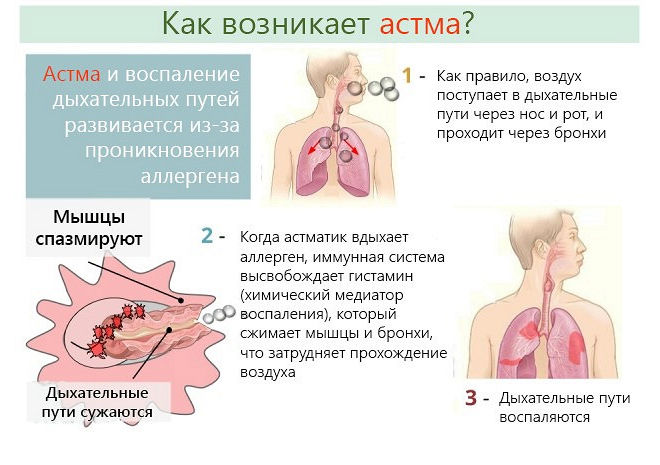 Лечение лающего кашля у взрослых