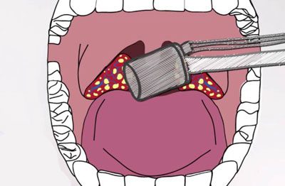 Чем опасен хронический тонзиллит основные симптомы и причины развития болезни