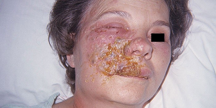 Воспаление тройничного нерва на лице симптомы и лечение