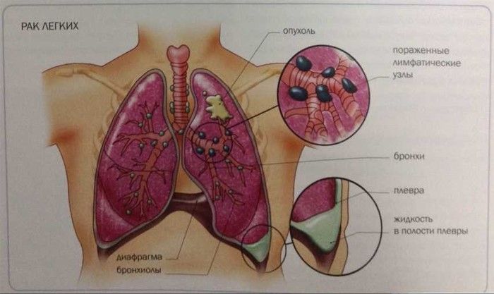 Причины и лечение кашля с болью в грудной клетке