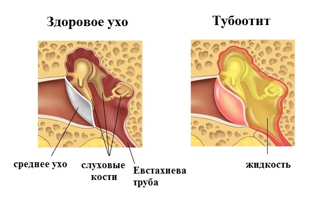 Тубоотит