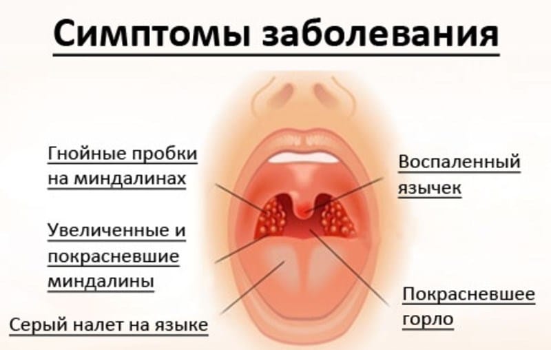 Основные симптомы заболевания