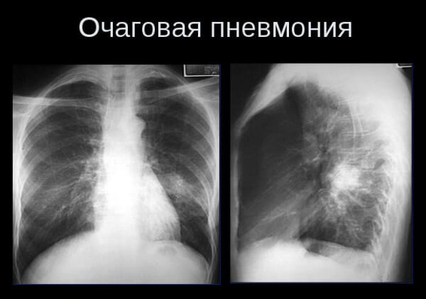 Симптомы и лечение очаговой пневмонии